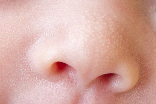 Milia or white spots in newborns