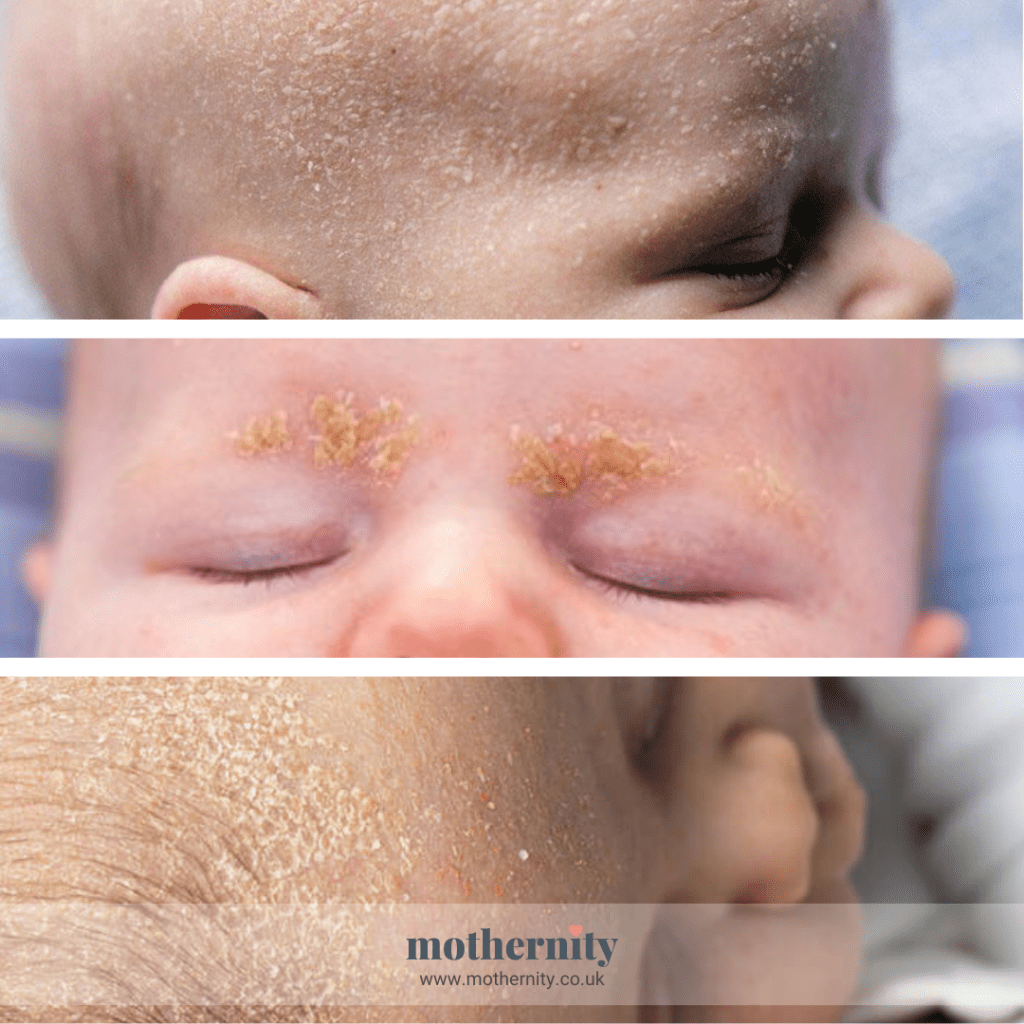 Cradle cap or seborrheic dermatitis in babies