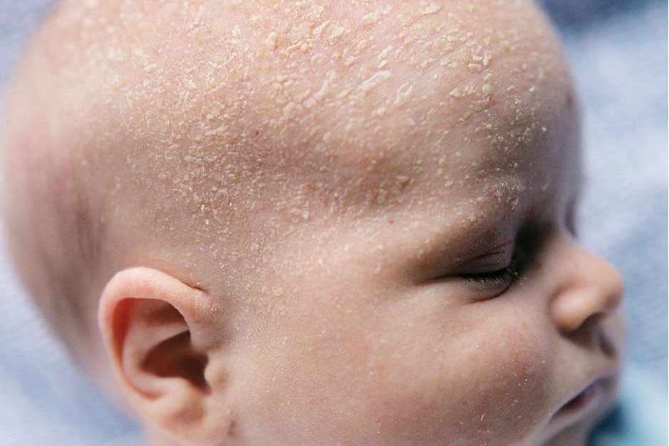 Cradle cap in newborns