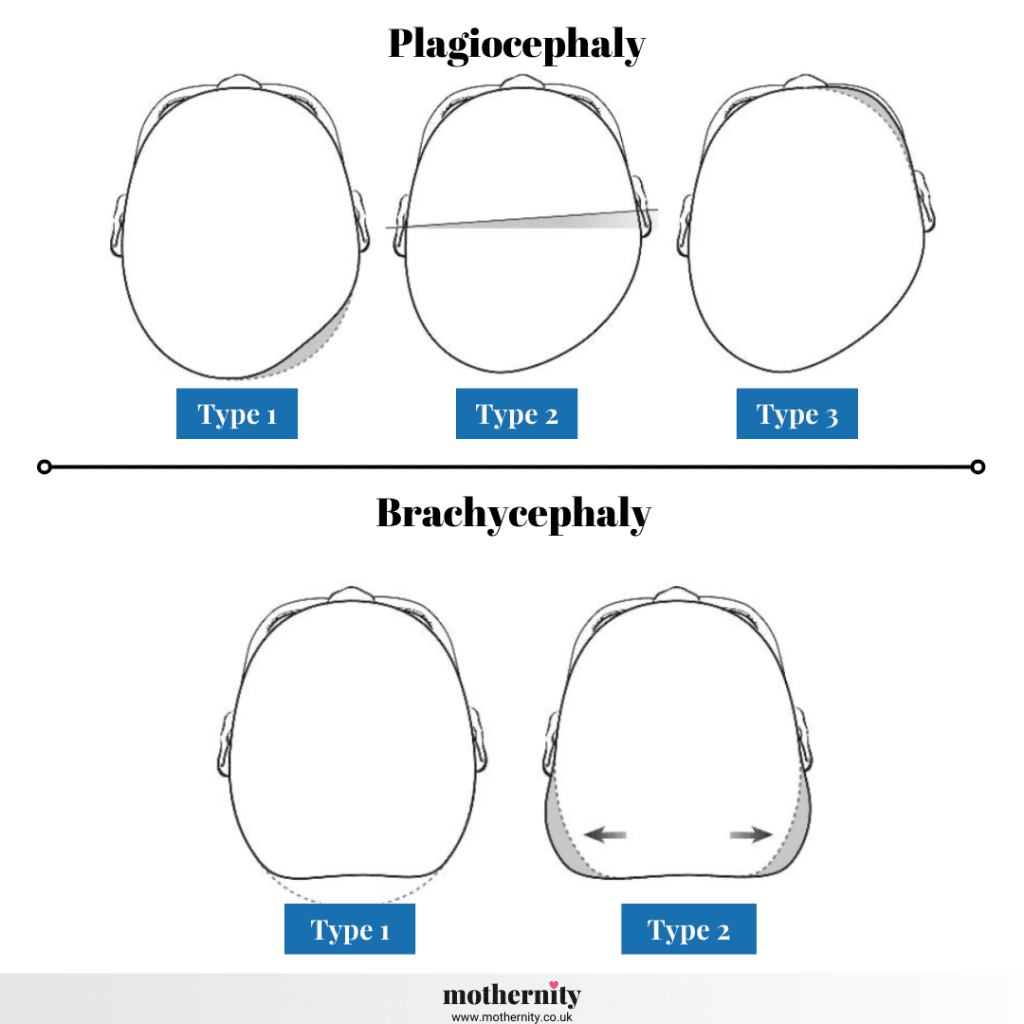 Plagiocephaly and Brachycephaly flat head syndrome severity