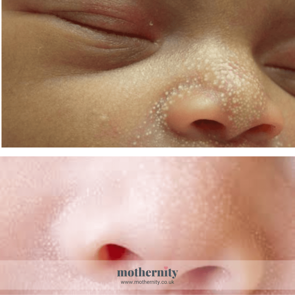 Milia or white spots in newborns